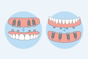model of immediate dentures