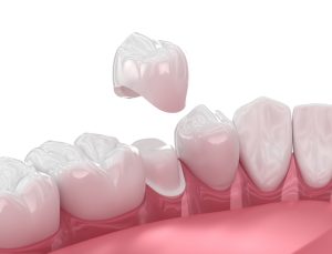 3d model of a dental crown